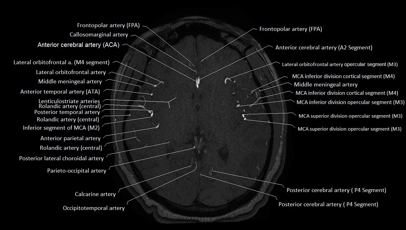MRA brain (cerebral arteries) anatomy axial 3T image 27.webp